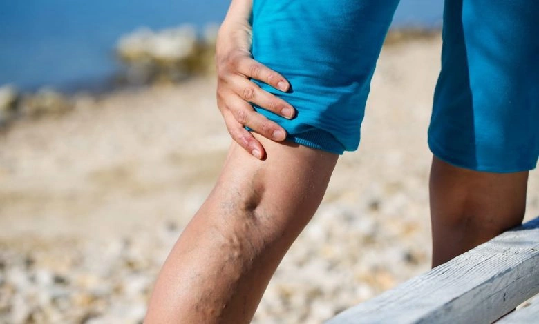 علاج الدوالى